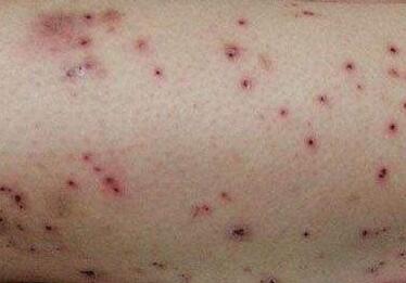 珠海哪家皮肤病医院治毛囊炎专业，珠海广肤皮肤科